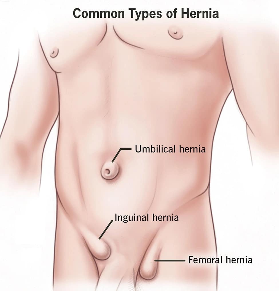Types-of-hernia